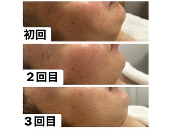 ベル 西新宿(Belle)の写真/【乾燥・赤み・毛穴悩みへ】丁寧なカウンセリングで原因を特定し、健康で美しい素肌へ導きます♪