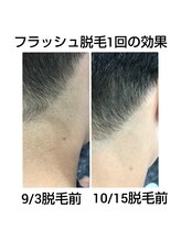 アンジェリーナ/メンズ脱毛　最新冷却機能搭載！