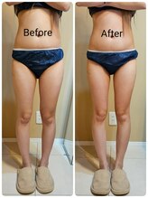 コハサロン(COHA SALON)/キャビテーション1回での効果！