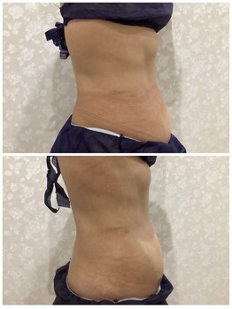 ディオーネ(Dione)/たった一度でこの効果!!