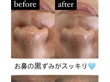 ブルーシー(BLUESEA)/毛穴洗浄