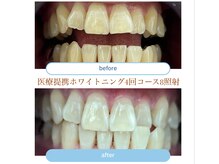 セルフメイド イオンタウン防府店(SELF MADE)の雰囲気（医療提携セルフホワイトニング4回コースのビフォーアフター）