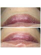 アーヒル(A”-HILU)/ワックス脱毛