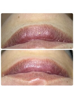 アーヒル(A”-HILU)/ワックス脱毛