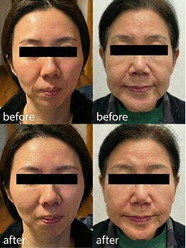 まえかわ鍼灸整骨院/美容鍼ビフォーアフター