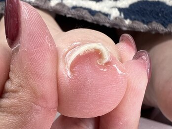シックネイル(CHIC NAIL)の写真/《巻き爪でお悩みの方に》ケアしづらい巻き爪に。痛みの少ない丁寧な施術で長年の爪のお悩みを解消します◎