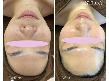 ストーリー 岐阜店(STORY)/ハーブピーリング専門店STORY