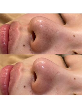 ブライダルエステ ジュエル(JEWEL)/毛穴エクストラクション