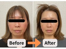 ブプラ 池田店(BUPURA)/たるみ引き締め☆