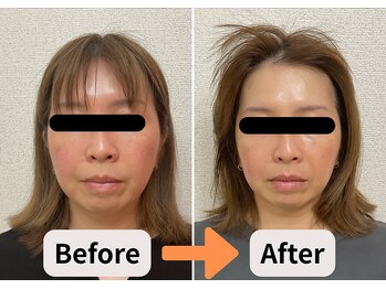 ブプラ 池田店(BUPURA)/小顔 たるみ シミ シワ 肌質改善