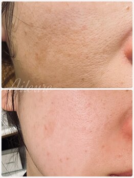 エルール トータルビューティ(Aileure total beauty)/最先端のVOSハーブピーリング