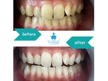 ティンクルホワイト 上尾店の雰囲気（業界初ホワイトニング法施術後のBefore/After）