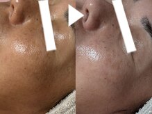 リコ(Ricco)/シミくすみ改善ハーブ