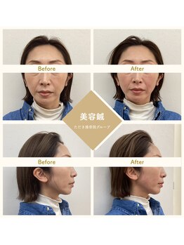 ただき接骨院 整体院 高崎本院/深層リフトケア美容鍼