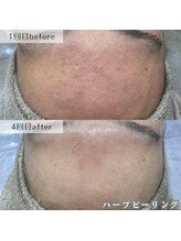 ネイルズビー 別邸(Nail's be)/メンズも肌質改善する時代