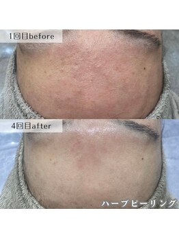 ネイルズビー 別邸(Nail's be)/メンズも肌質改善する時代