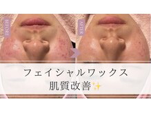ジョリー(JOLIE)の雰囲気(ニキビ肌の改善もお任せください!)