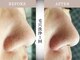 モルティー 広島店(Molti)の写真/【肌改善・毛穴洗浄サロン】黒ずみや詰まりをすっきり除去×BT-Xパックで毛穴引き締めツルツル肌をキープ！