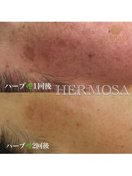 エメ 心斎橋(Aimer)/ハーブピーリングの感動の効果