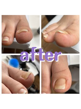 ラピス(Lapis)/巻爪ケア