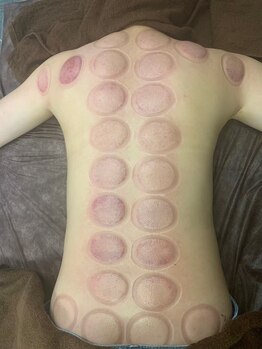 リベル(Liber)/カッピング効果