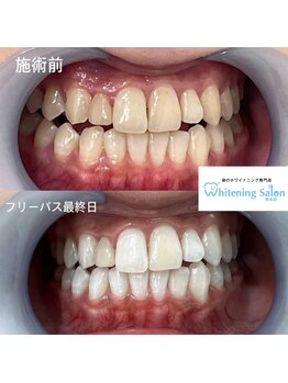ホワイトニングサロン 熊本店/街中セルフホワイトニング