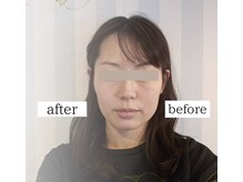 ルノン(LUNON)/小顔矯正