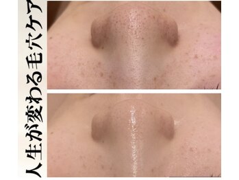 ブレア(Blair)/毛穴のお掃除