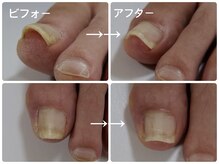 プリード 日進香久山店(PULIDO)/巻き爪ケアフレックスプレート