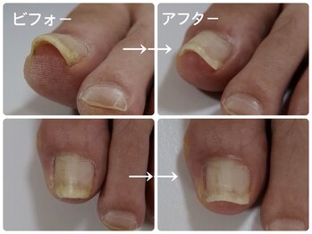 プリード 日進香久山店(PULIDO)/巻き爪ケアフレックスプレート