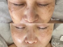 イースト(EAST)/シミプラズマフルコース10回以上