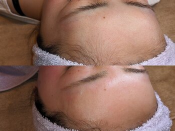 ムーン 横浜(MOON)/【おでこの産毛】