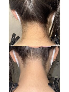 ワイズサロン(Y's salon)/うなじ脱毛