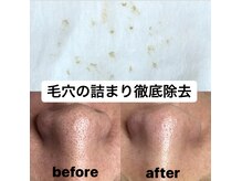 ビューティーネイル(Beauty Nail)/毛穴エクストラクション