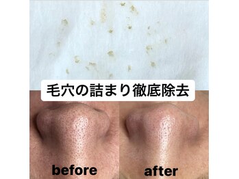 ビューティーネイル(Beauty Nail)/毛穴エクストラクション