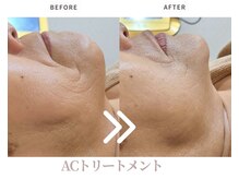 エステティックサロン ラ ベルタ(Esthetic Salon La Belta)/ACトリートメント6回