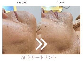 エステティックサロン ラ ベルタ(Esthetic Salon La Belta)/ACトリートメント6回