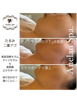 アネランスパ(Anelan Spa.)/あご下のたるみ、二重アゴに!