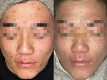 フルール ニコ(Fleur Nico)/6回のBeforeAfter