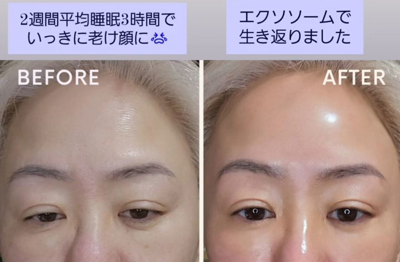 フォト｜水光ピールスキン｜ホットペッパービューティー