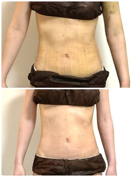 慧花(keika)/インディバ美容施術後ケア