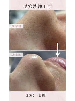 ル シャ/メンズ脱毛/毛穴洗浄/ヘッドスパ