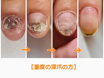 レアム/ずっと黒い爪が気になってる。