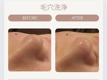 美々庵/ハイドラ 毛穴洗浄