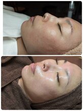 ウララ(ulala)/韓国ピーリング初回/3回目