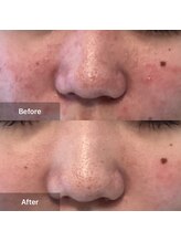 モカ 天王寺店(MOKA)/剥離2回　ニキビケア　赤ら顔