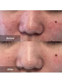 モカ 天王寺店(MOKA)/剥離2回　ニキビケア　赤ら顔