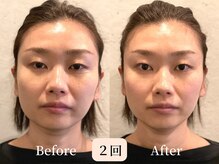 ロシュニ/40代 お悩み:たるみ/歪み/腰痛