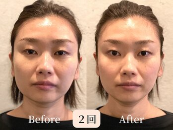 ロシュニ/40代 お悩み:たるみ/歪み/腰痛