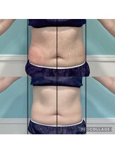 ビーナスアイスブルー(Venus ICE BLUE)/脂肪冷却5回